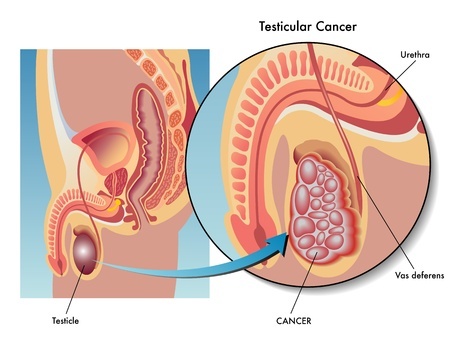 Right Testicular Mass in a 28-yo Man