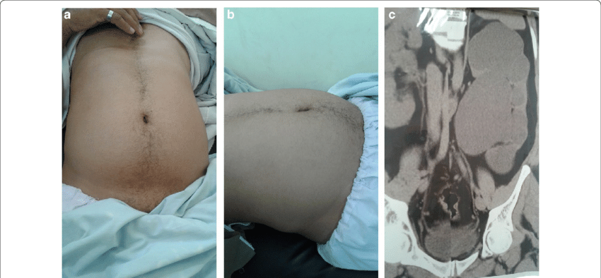 Left-sided Abdominal Pain in a 45-yr-old Man