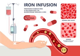 Most recent study suggests preoperative iron infusions work better than blood transfusions for some anemic patients