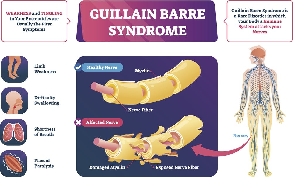 Guillain-Barre Syndrome as an Extraintestinal Manifestation of Crohn's Disease