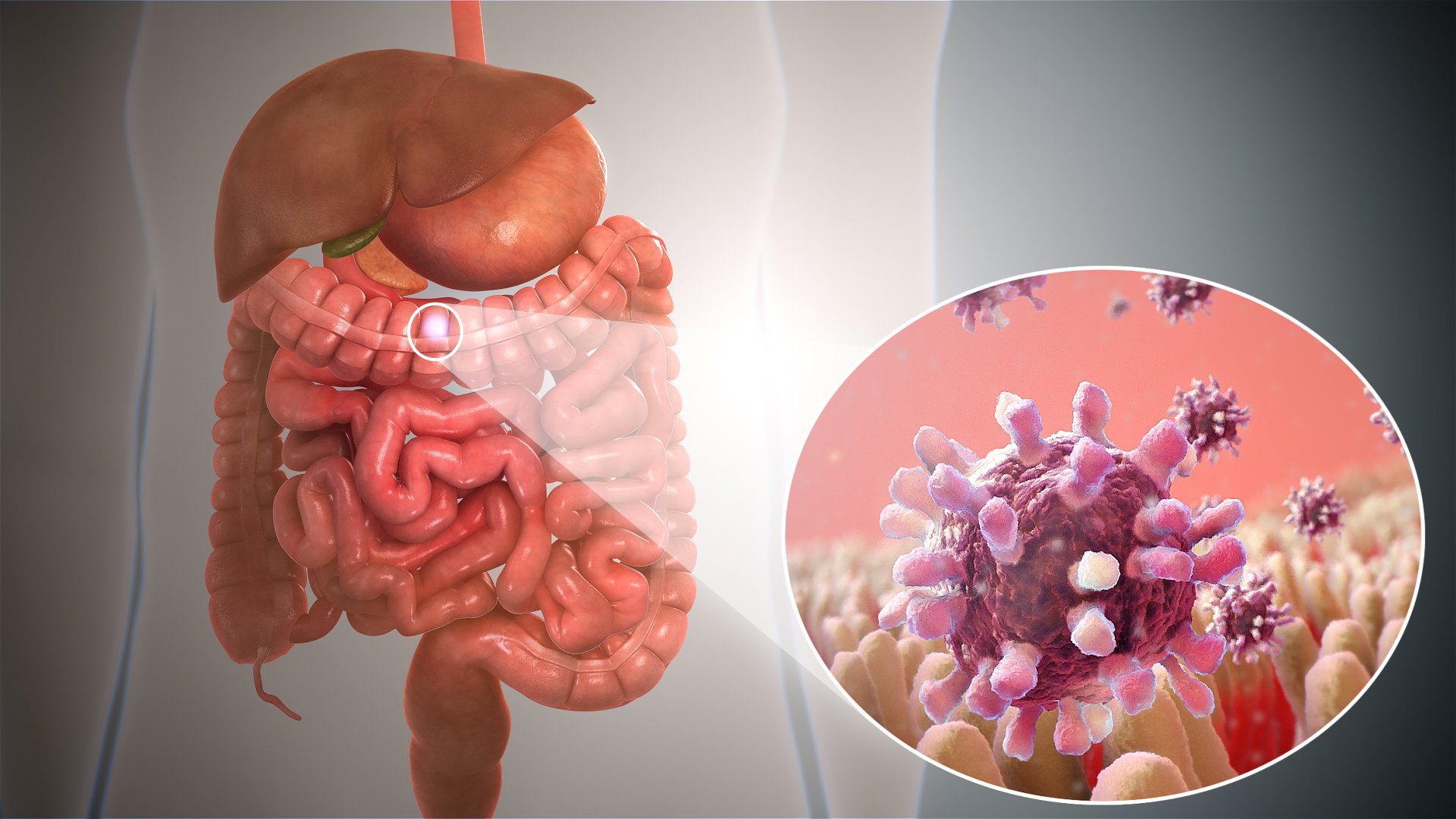 Gastroenteritis ("Stomach Flu")