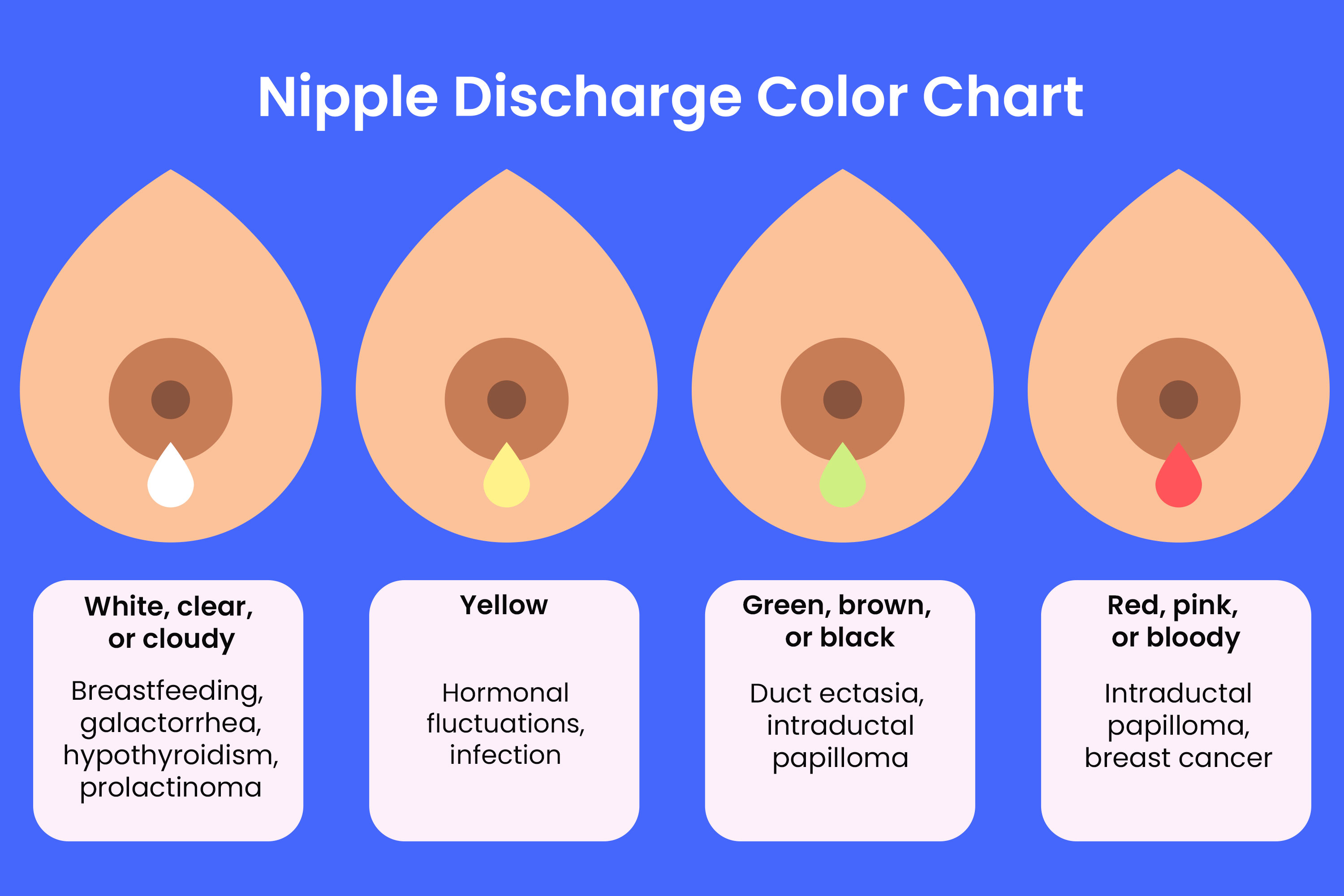 Nipple discharge in a 31 yo female